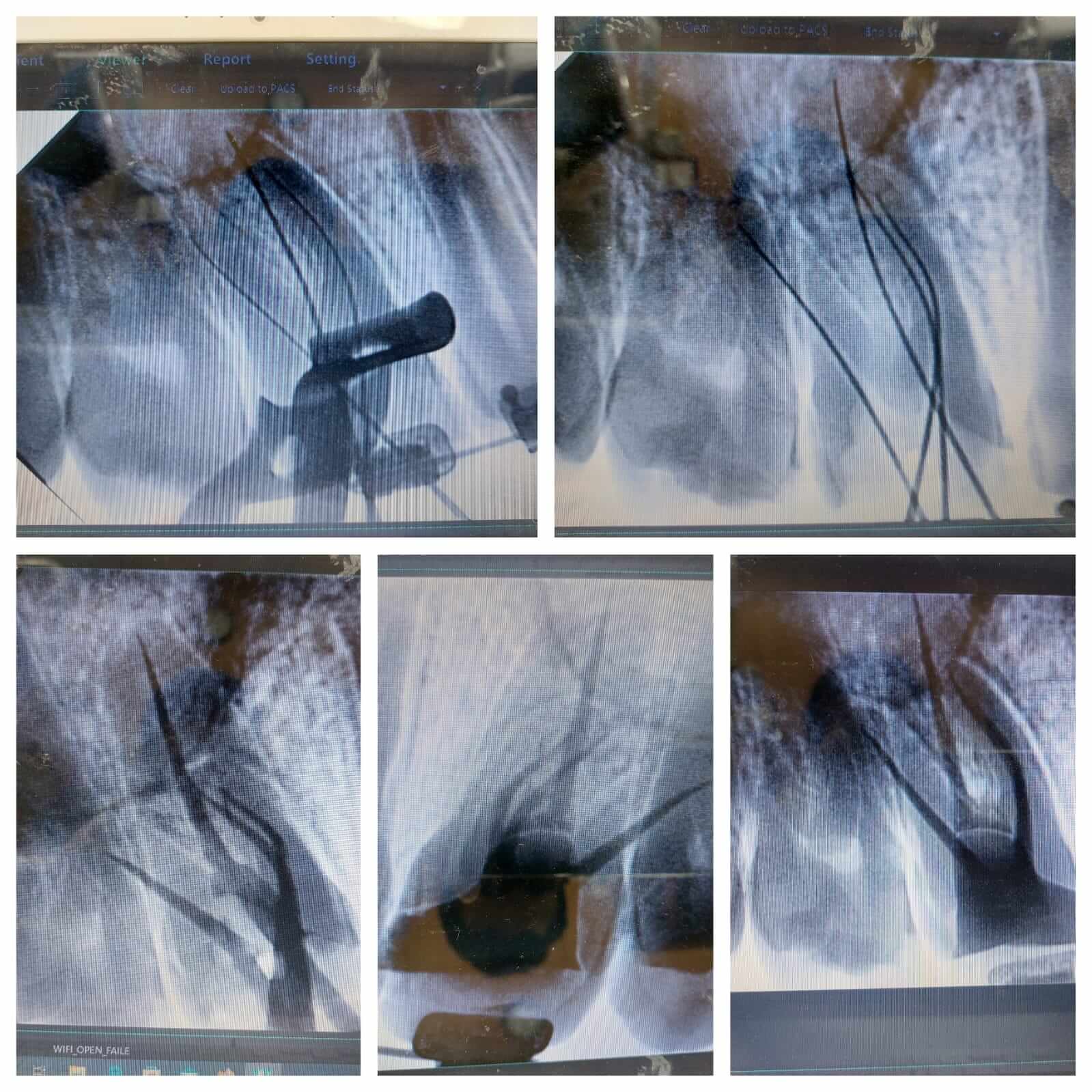 Precise root canal treatment: Working lengths measured accurately, including the important MB2 canal. - Performed at Dental Pearl Clinic Lahore