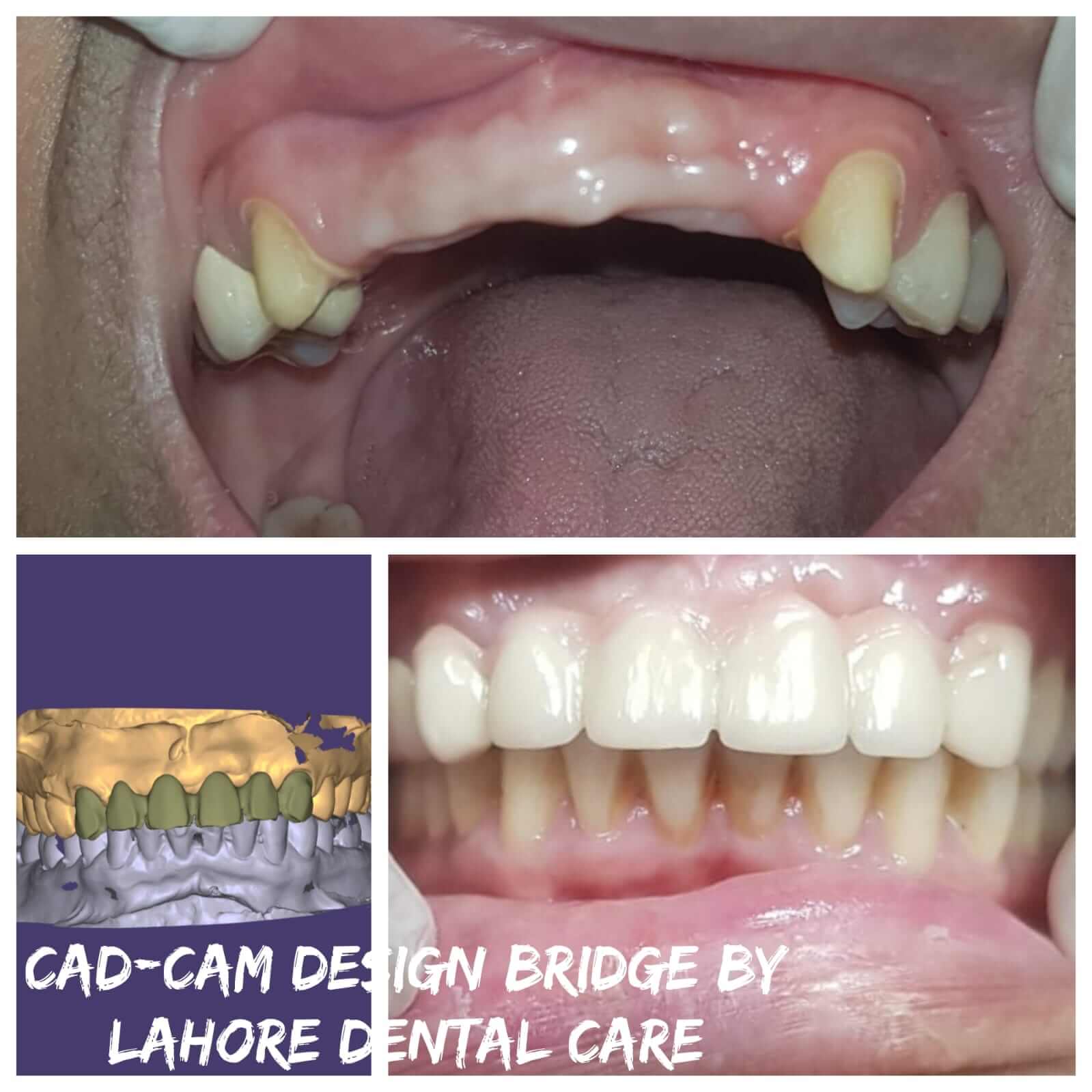Anterior teeth replacement using advanced CAD/CAM PFM crowns. - Performed at Dental Pearl Clinic Lahore