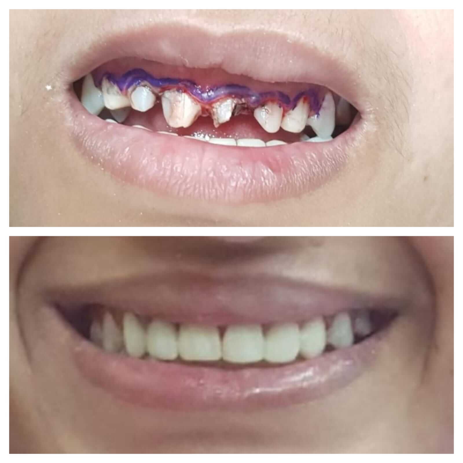 Smile transformation: Broken teeth replaced with durable zirconia crowns. - Performed at Dental Pearl Clinic Lahore