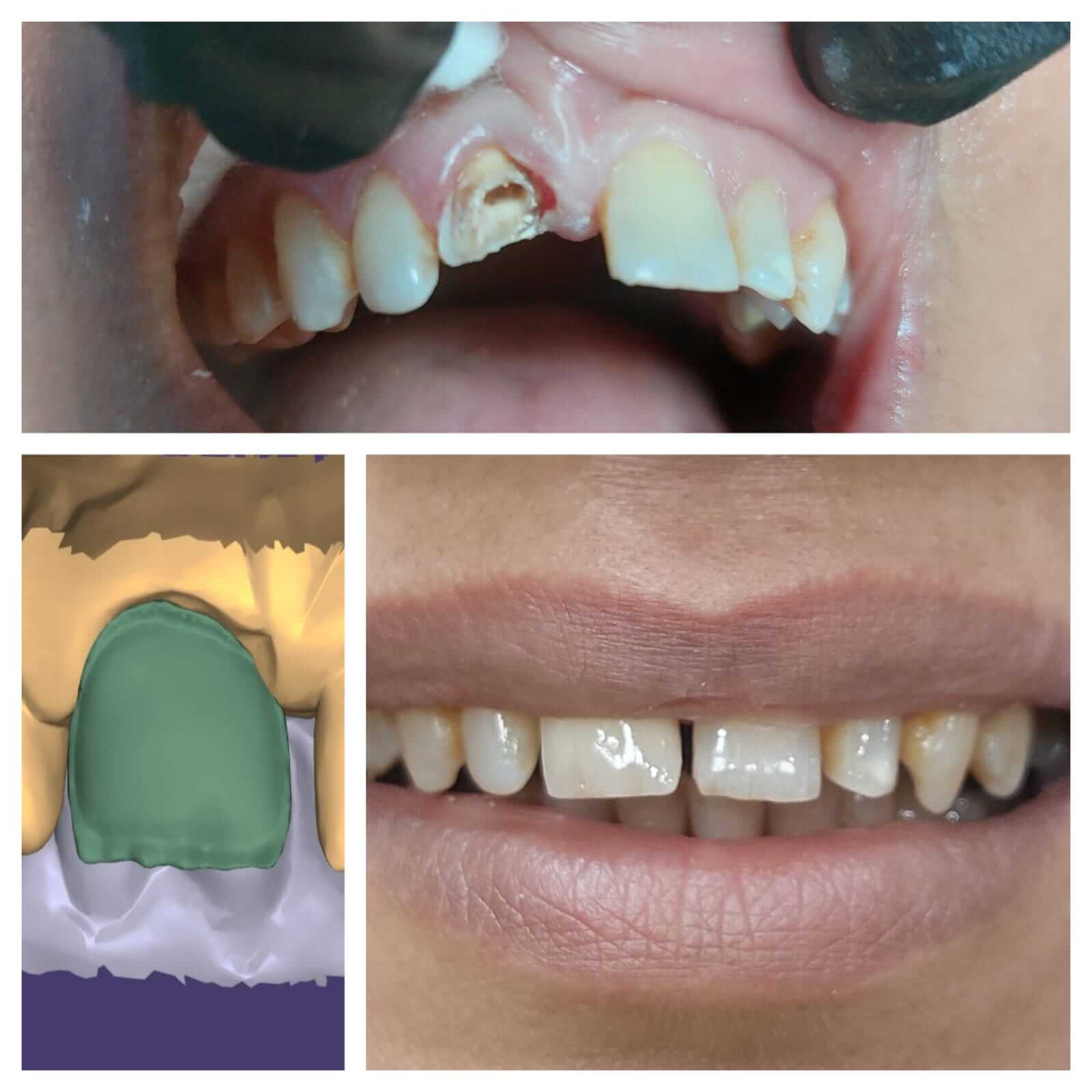 Smile transformed: Broken incisor replaced with durable zirconia crown. - Performed at Dental Pearl Clinic Lahore