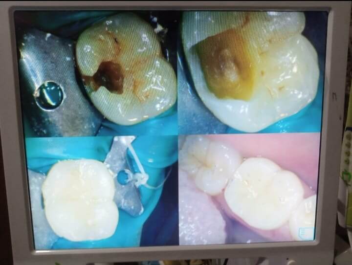 Indirect pulp capping with clean, aesthetic composite outcome. - Performed at Dental Pearl Clinic Lahore