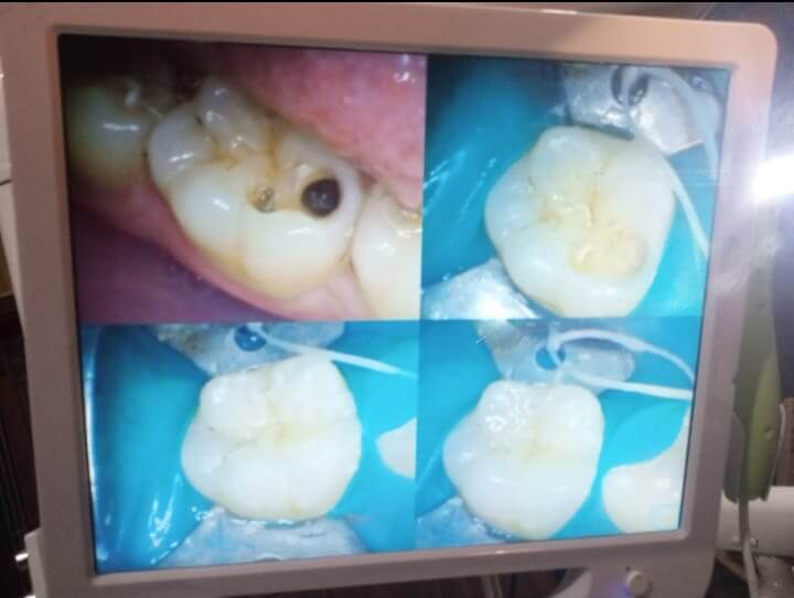 Indirect pulp capping with clean, aesthetic composite outcome. - Performed at Dental Pearl Clinic Lahore
