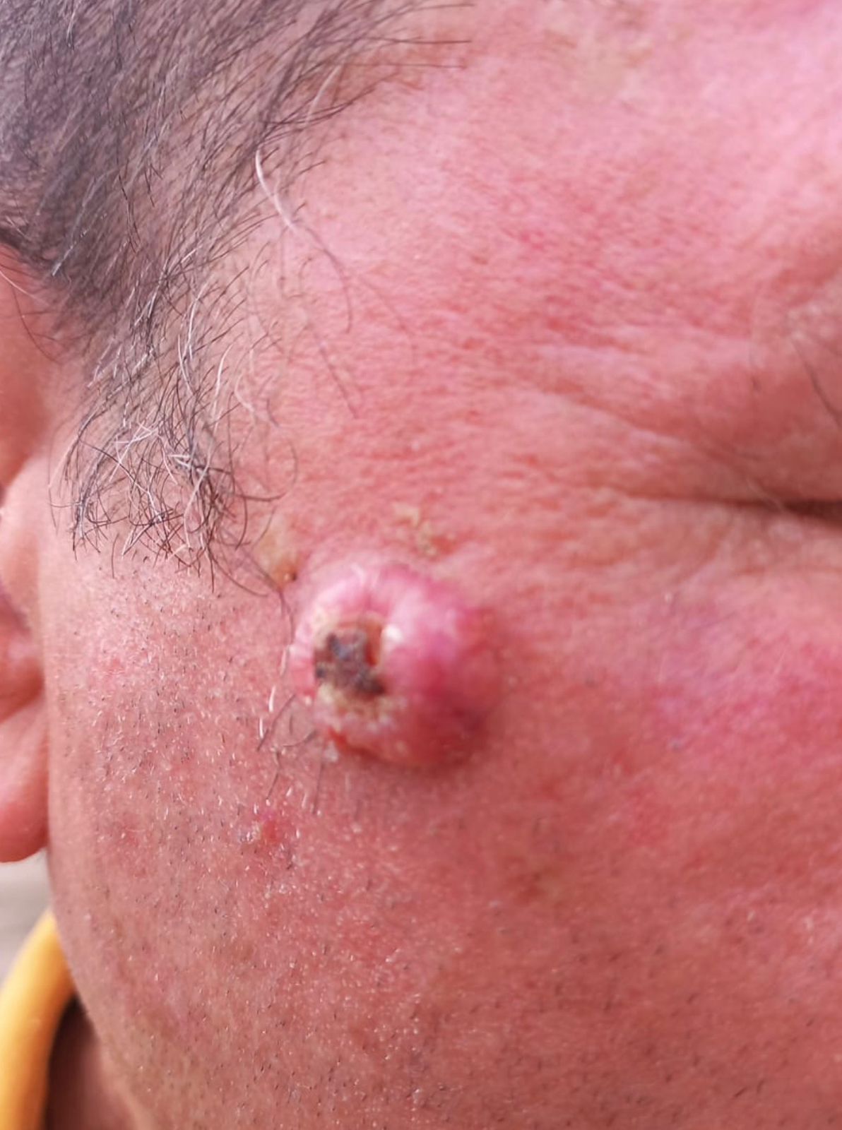 Tumor Facial