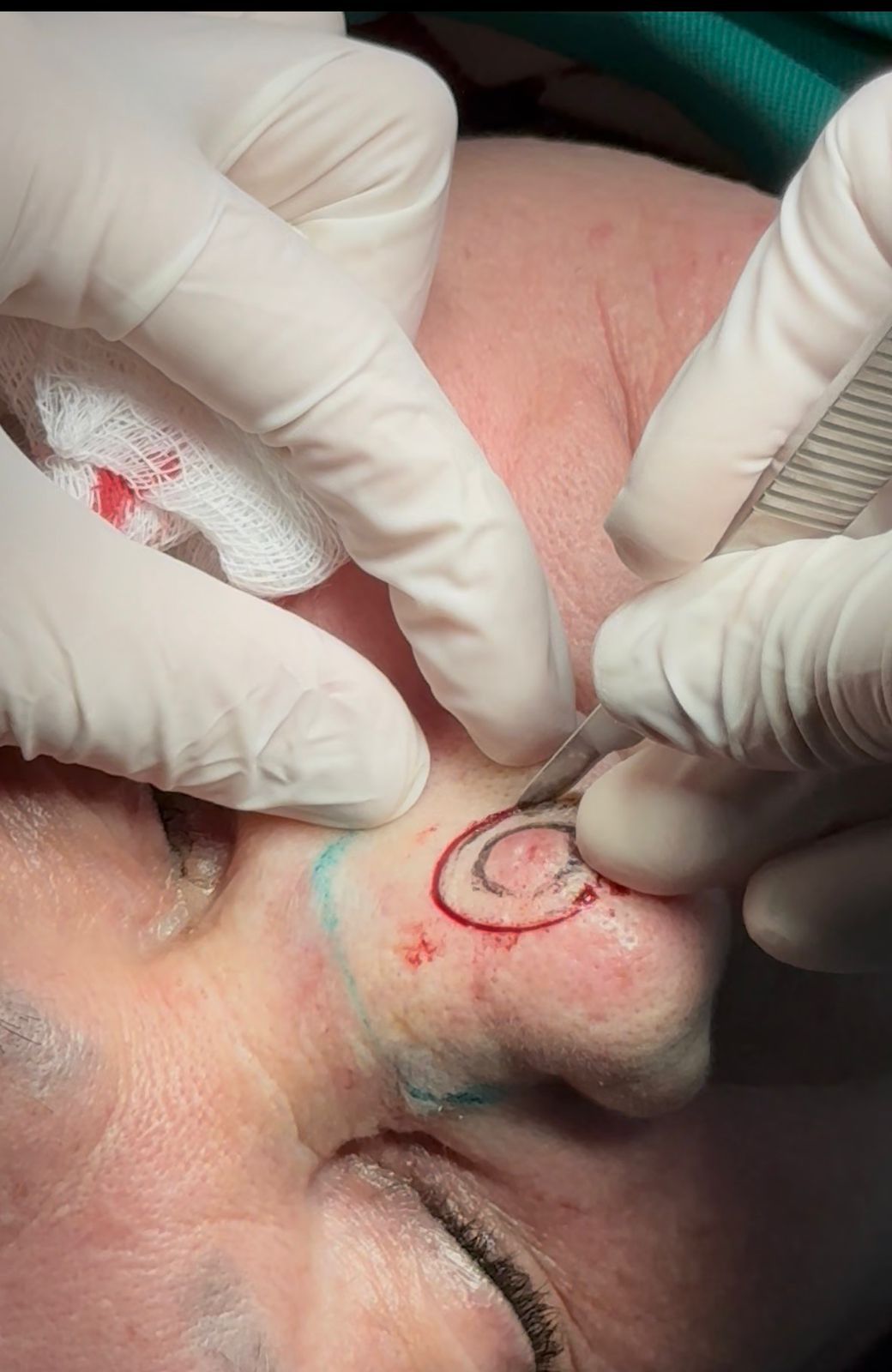 Tumor Nasal